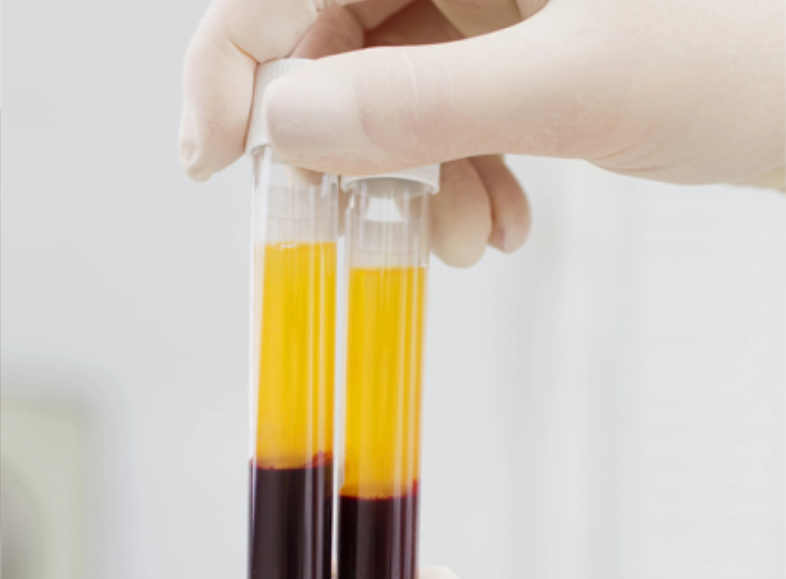 PRP NEDİR, KULLANIM ALANLARI NELER